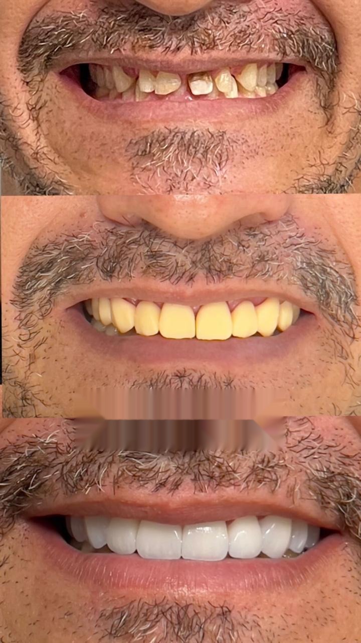 Antes e depois de reabilitação oral completa