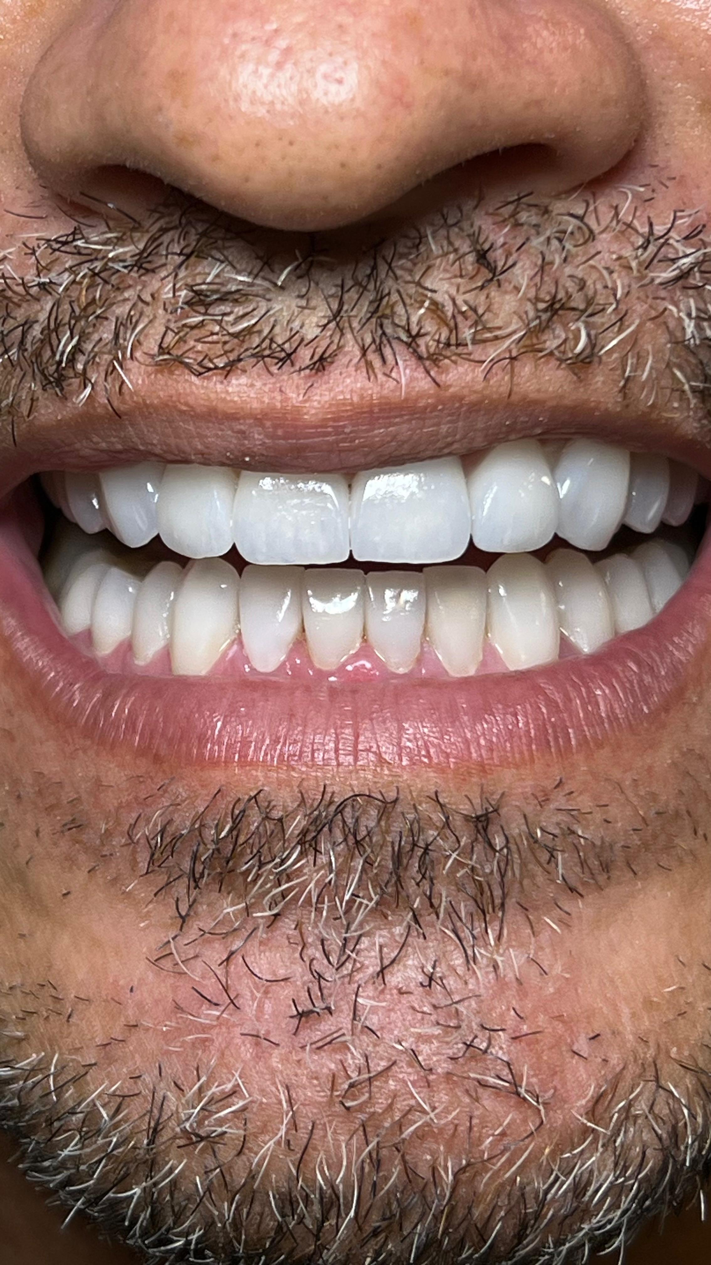 Sorriso finalizado com facetas de cerâmica