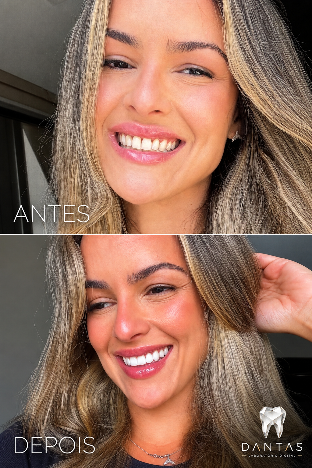 Antes e depois de lentes de contato dental