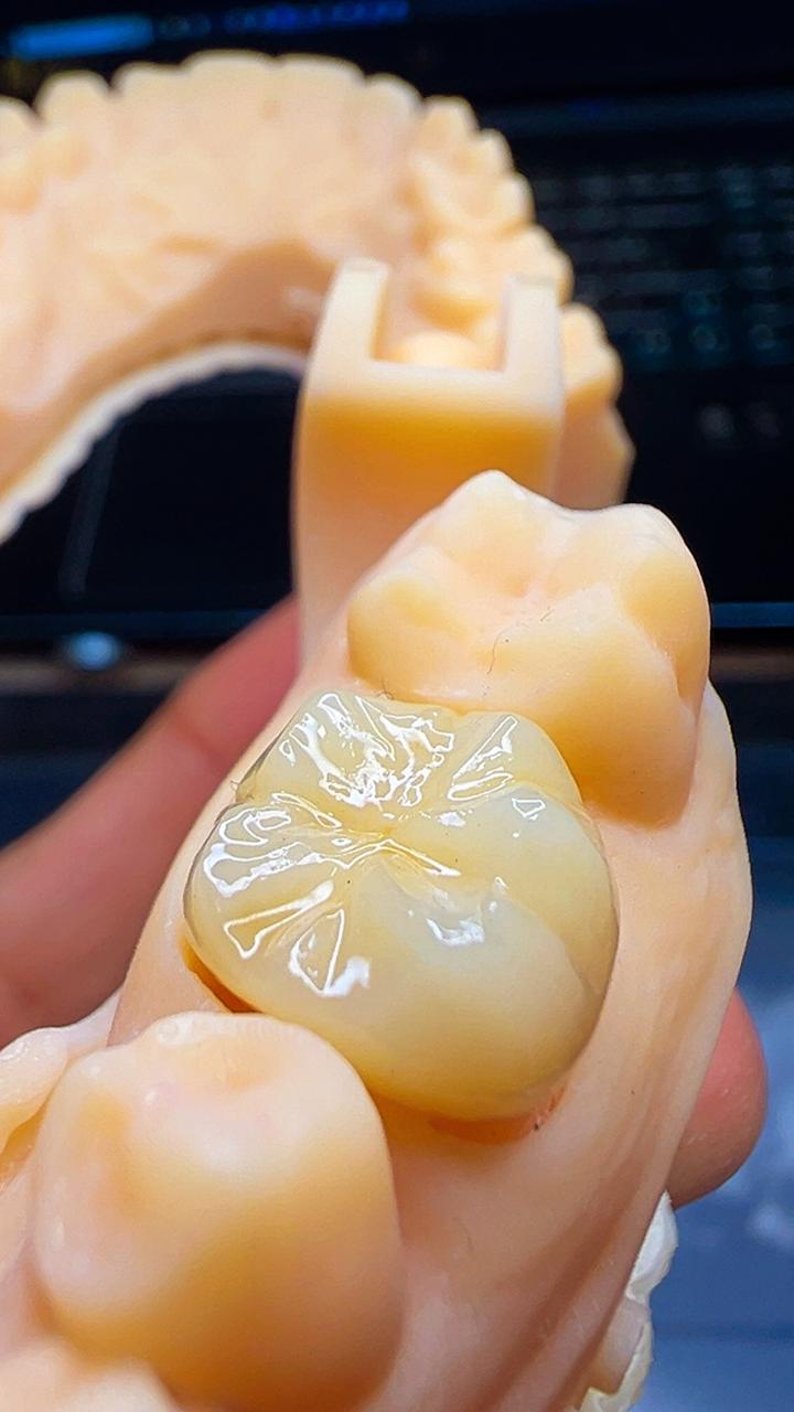 Dissilicato de Lítio / E.max — imagem 2