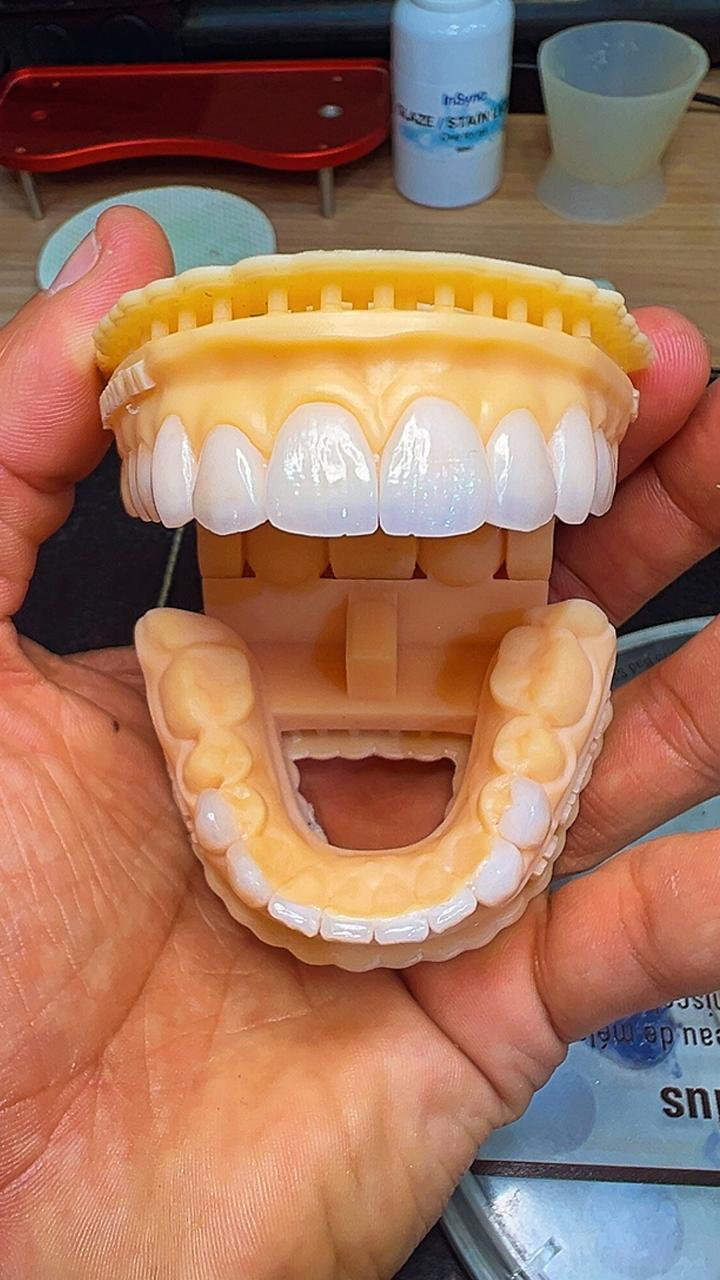 Dissilicato de Lítio / E.max — imagem 3